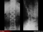 Radiographies normales du rachis lombaire (face et profil)