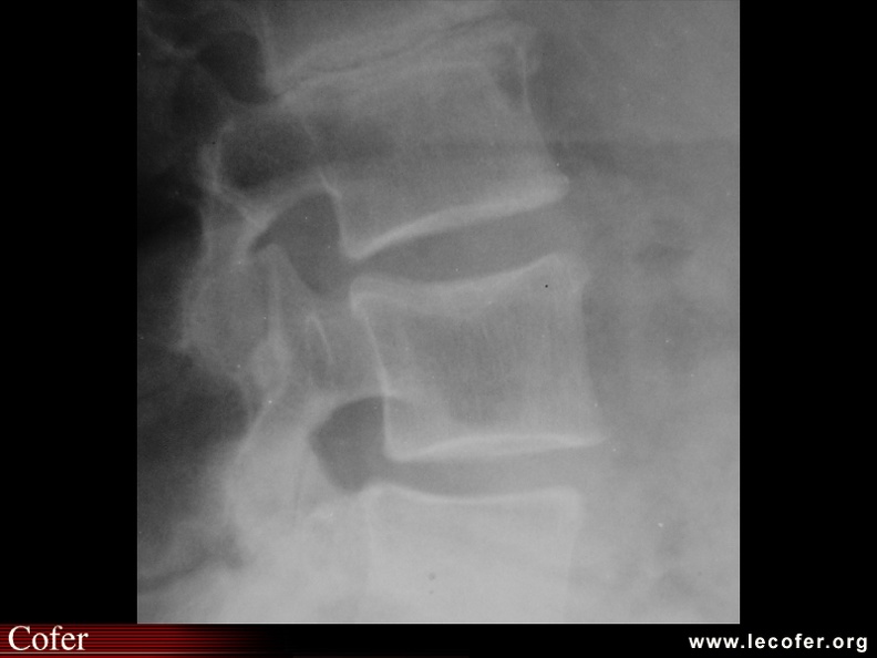 Fracture vertébrale de grade 1 du rachis lombaire