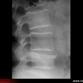 Fracture vertébrale de grade 2 du rachis lombaire