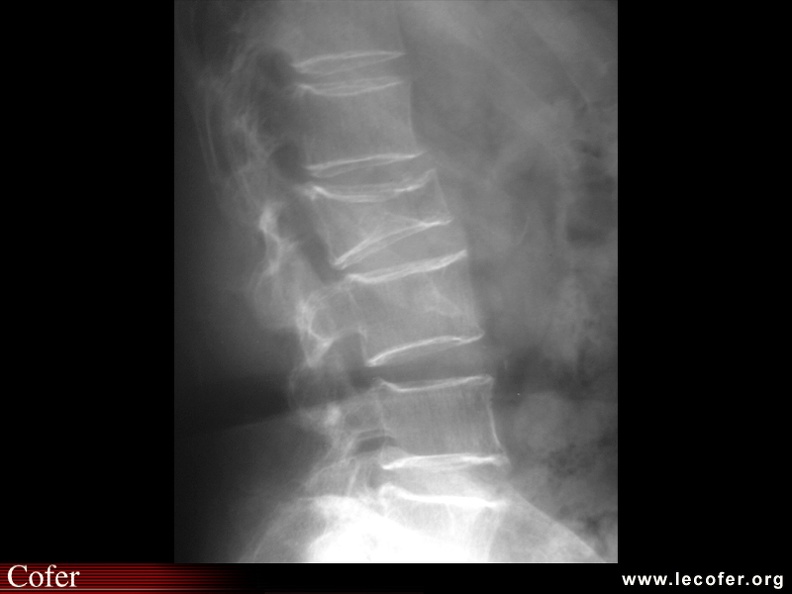 Fracture vertébrale de grade 3 du rachis lombaire | Diapothèque du ...