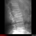 Fracture vertébrale de grade 3 du rachis lombaire