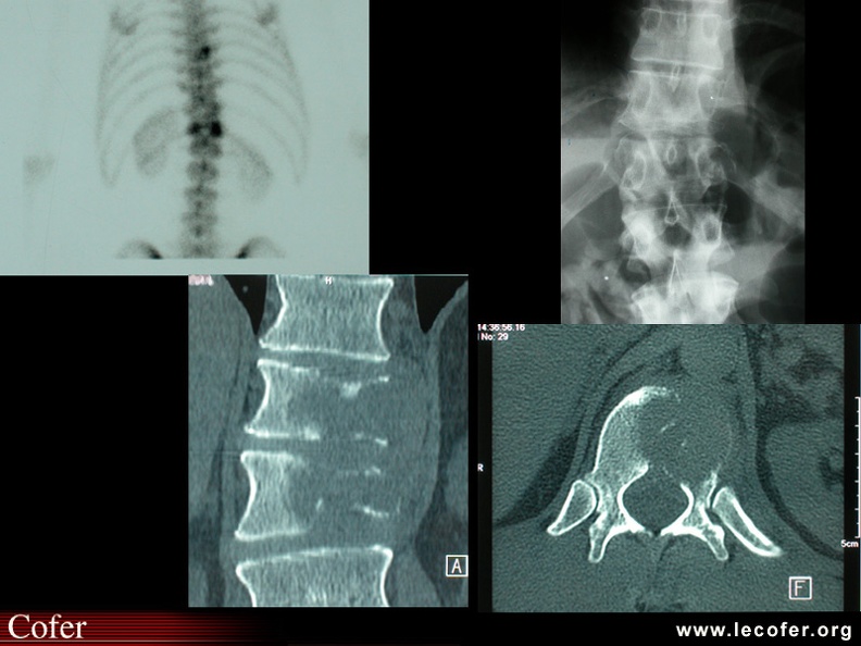 Fixation asymétrique d’une vertèbre métastatique, métastase osseuse