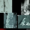 Fixation asymétrique d’une vertèbre métastatique, métastase osseuse