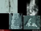 Fixation asymétrique d’une vertèbre métastatique, métastase osseuse