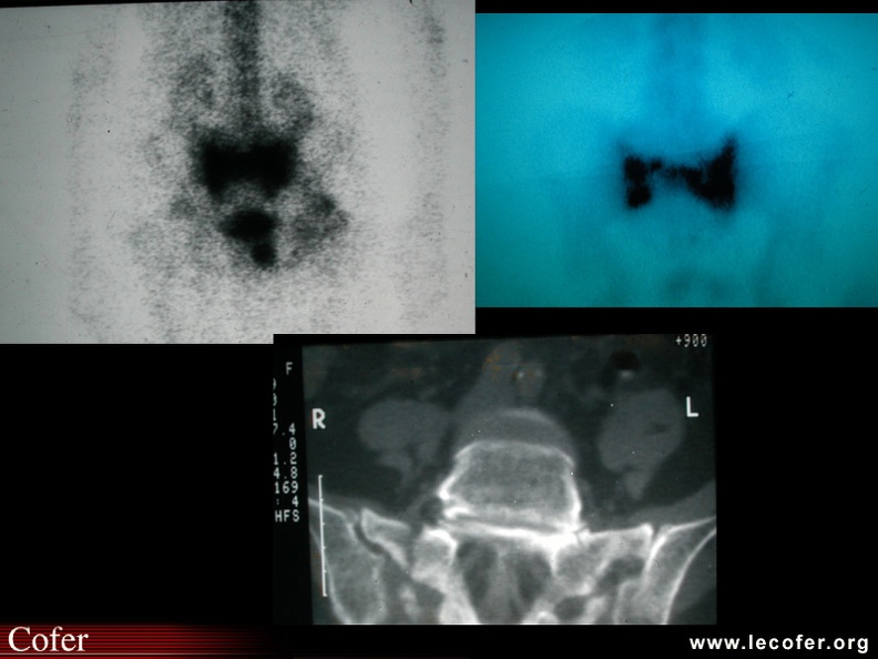 a. Scintigraphie osseuse, cliché centré sur le bassin. Hyperfixation intense sur le sacrum réalisant l'aspect en « H » caractéristique d'une fracture ostéoporotique du sacrum.
b. Les 3 composantes du « H » sont mieux visibles : deux foyers verticaux correspondant aux fractures des ailerons sacrés et trait de refend horizontal à travers corps de S1.
c. Coupe TDM visualisant les traits fracturaires des ailerons sacrés. 050102035.jpg