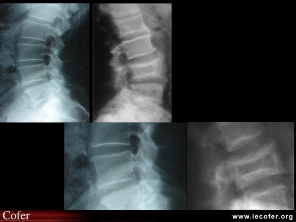 Maladie de Paget : vertèbre en cadre