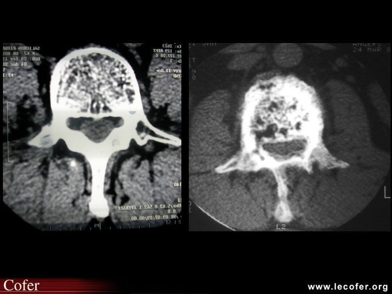 Maladie de Paget : tomodensitométrie de vertèbre