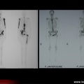 Maladie de Paget : scintigraphie osseuse avec lésions multiples