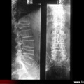 Myélome multiple : radiographie : fractures vertébrales