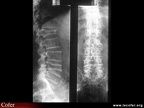 Myélome multiple : radiographie : fractures vertébrales