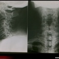 Myélome multiple : radiographie : vertèbre non visible