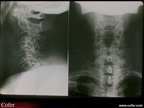 Myélome multiple : radiographie : vertèbre non visible