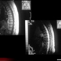 Myélome multiple : IRM : atteinte nodulaire des corps vertébraux