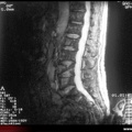 Myélome multiple : IRM : fracture d’une vertèbre lombaire