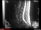 Myélome multiple : IRM : fracture d’une vertèbre lombaire