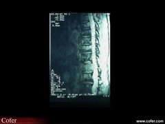 Myélome multiple : IRM : Bombement du bord postérieur d’une vertèbre menaçant le névraxe