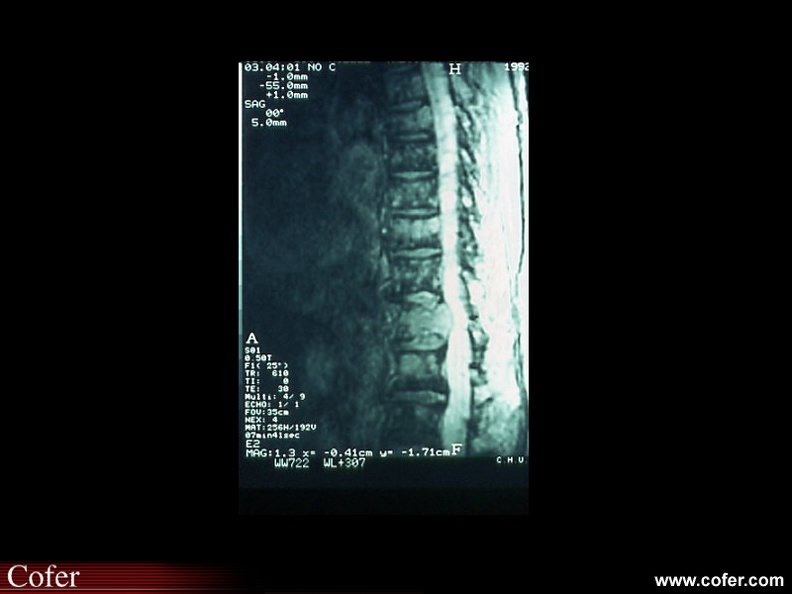 Myélome multiple : IRM : Bombement du bord postérieur d’une vertèbre menaçant le névraxe