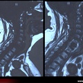 Myélome multiple : IRM : Épidurite myélomateuse