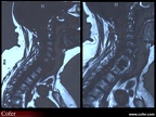 Myélome multiple : IRM : Épidurite myélomateuse