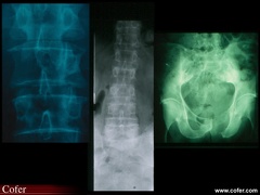 Métastases osseuses lytiques : perte de structures osseuses