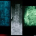 Métastases osseuses lytiques : perte de structures osseuses