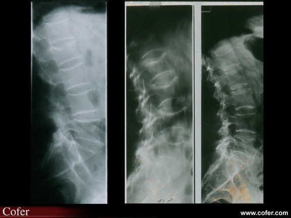 Métastases osseuses : comparaison des fractures vertébrales métastatiques et ostéoporotiques