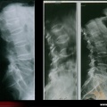 Métastases osseuses : comparaison des fractures vertébrales métastatiques et ostéoporotiques