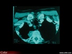 Métastases osseuses : Métastase vertébrale lytique d’origine mammaire vue en tomodensitométrie