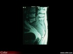 Métastases osseuses : Métastase vertébrale dorsale menaçant le névraxe