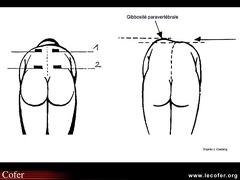 Scoliose et attitude scoliotique