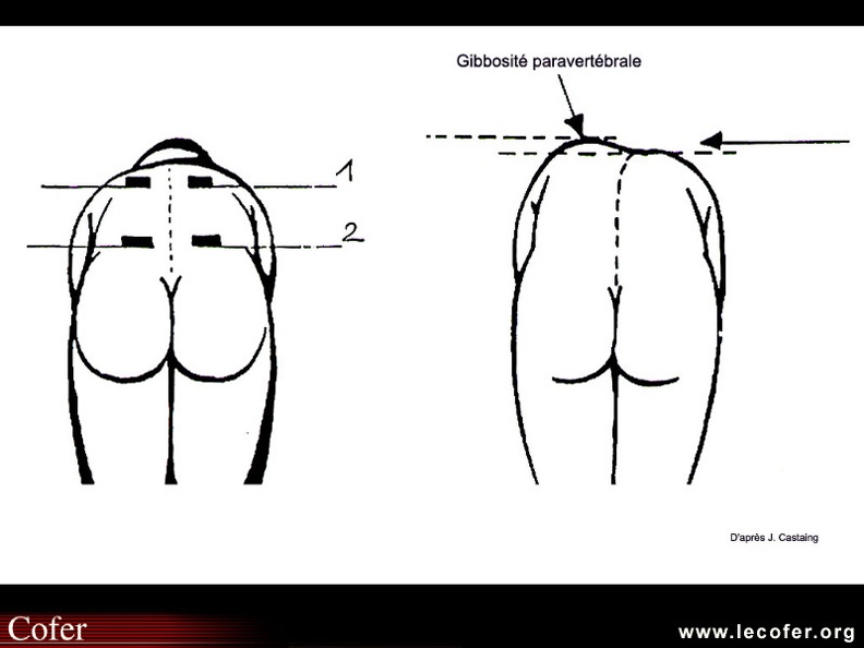 Scoliose et attitude scoliotique