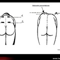 Scoliose et attitude scoliotique