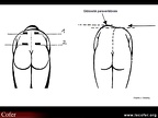 Scoliose et attitude scoliotique