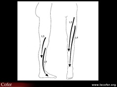 Cruralgie L3 L4 , lomboradiculalgie, lombocruralgie