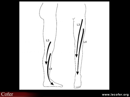 Cruralgie L3 L4 , lomboradiculalgie, lombocruralgie