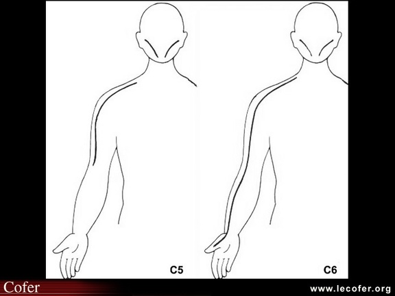 Sensibilité C5 et C6