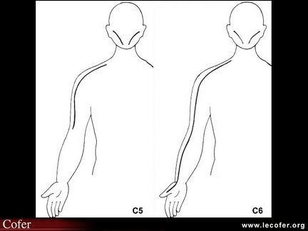 Sensibilité C5 et C6