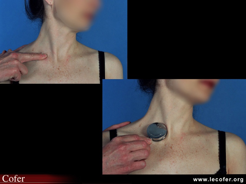 Sonnette et souffle sus-claviculaires. 060001082.jpg