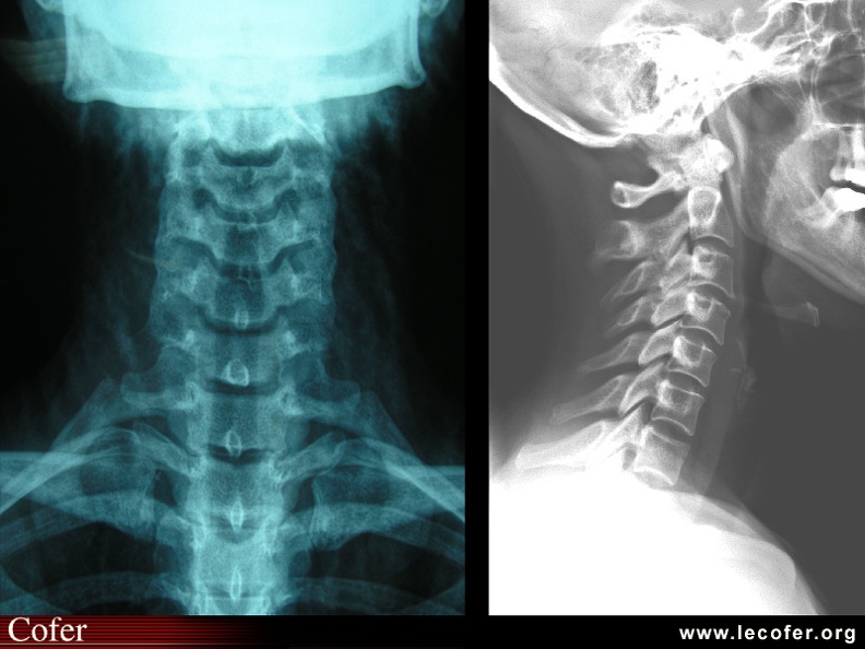 Radiographie du rachis cervical, sujet normal : face et profil. 060003001.jpg
