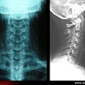 Radiographie du rachis cervical, sujet normal : face et profil