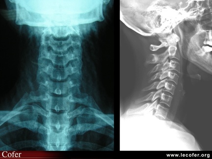 Radiographie du rachis cervical, sujet normal : face et profil