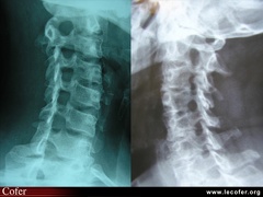 Radiographie du rachis cervical de ¾. Rétrécissement normal et foraminal