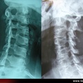 Radiographie du rachis cervical de ¾. Rétrécissement normal et foraminal