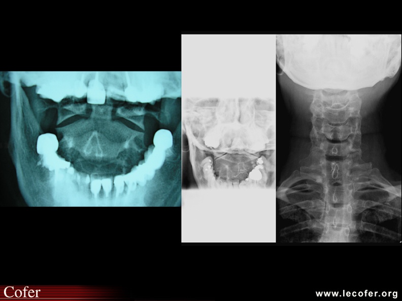 Radiographie C1C2, cliché bouche ouverte. Normal / pincement C1C2