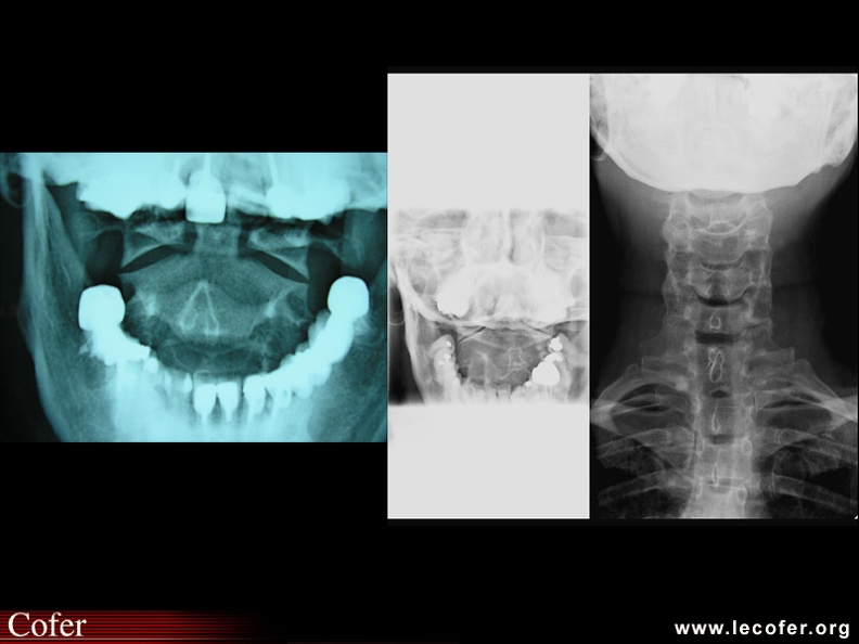 Radiographie C1C2, cliché bouche ouverte. Normal / pincement C1C2. 060003006.jpg