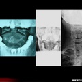 Radiographie C1C2, cliché bouche ouverte. Normal / pincement C1C2