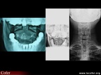Radiographie C1C2, cliché bouche ouverte. Normal / pincement C1C2