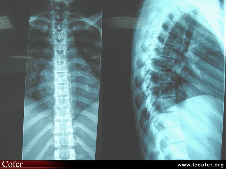 Radiographie du rachis dorsal, sujet normal : face et profil ...