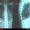 Radiographie du rachis dorsal, sujet normal : face et profil