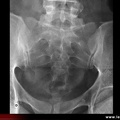 Radiographie du sacrum